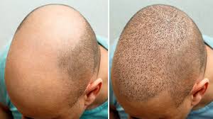 Best for Hair Transplants in Indore