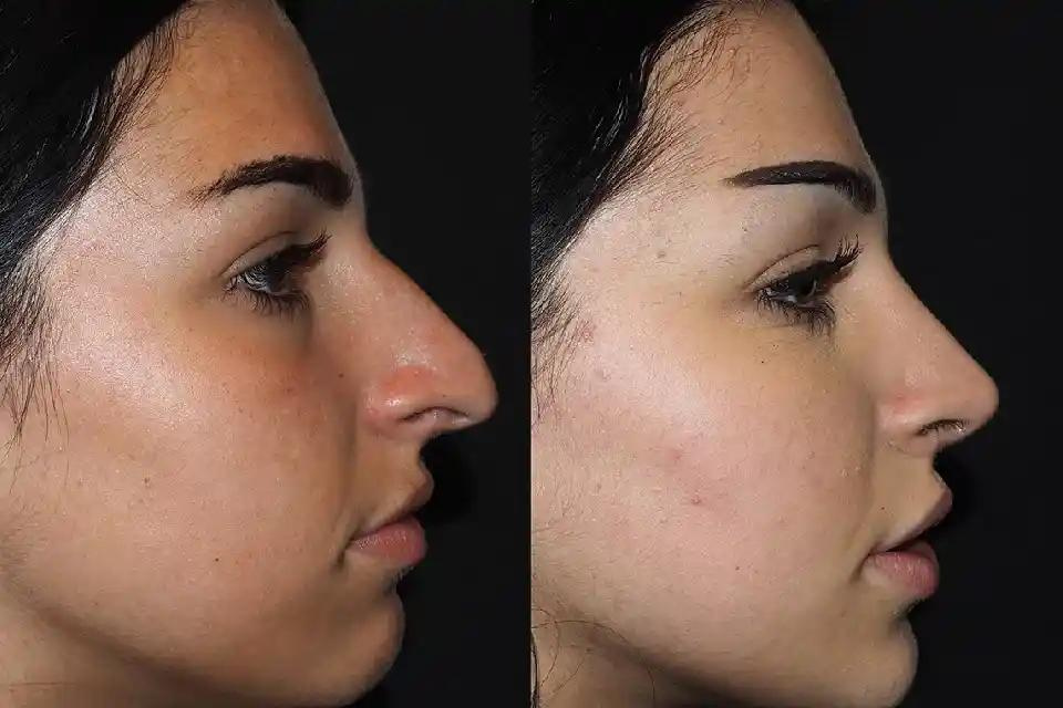 Post-Rhinoplasty Care: Tips for Long-Term Results in Dubai" - Maximize your rhinoplasty investment with expert post-operative care advice tailored for Dubai's climate and lifestyle.