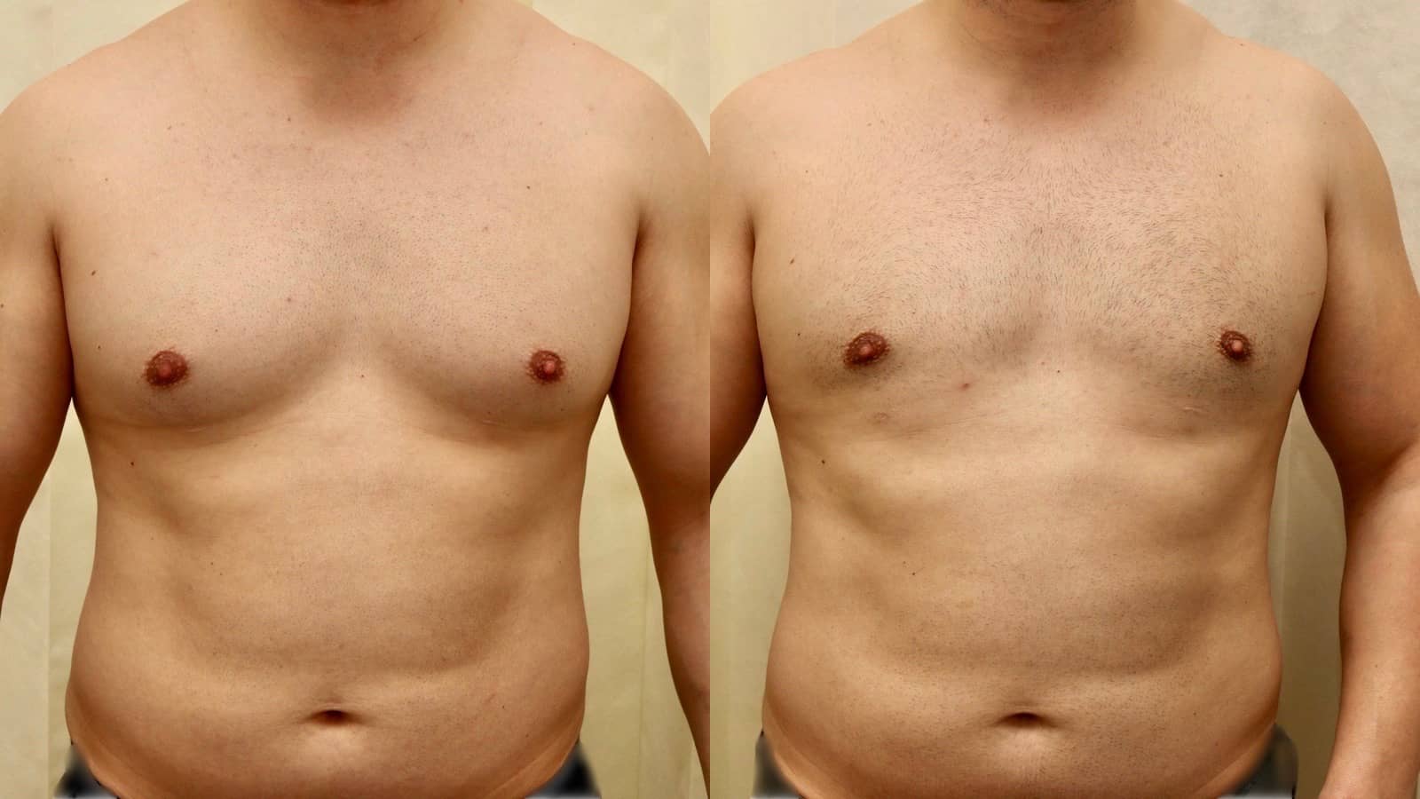 gynecomastia surgery abu dhabi